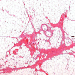 PDO collagen formation